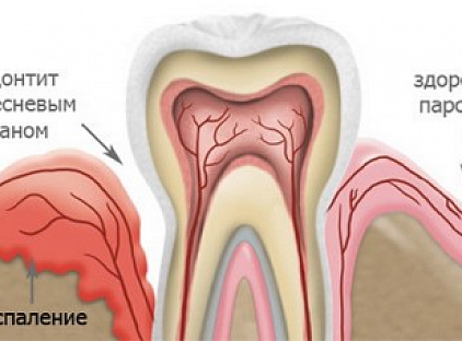 Консервативное лечение пародонтита