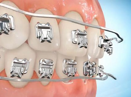Несъемные ортодонтические аппараты